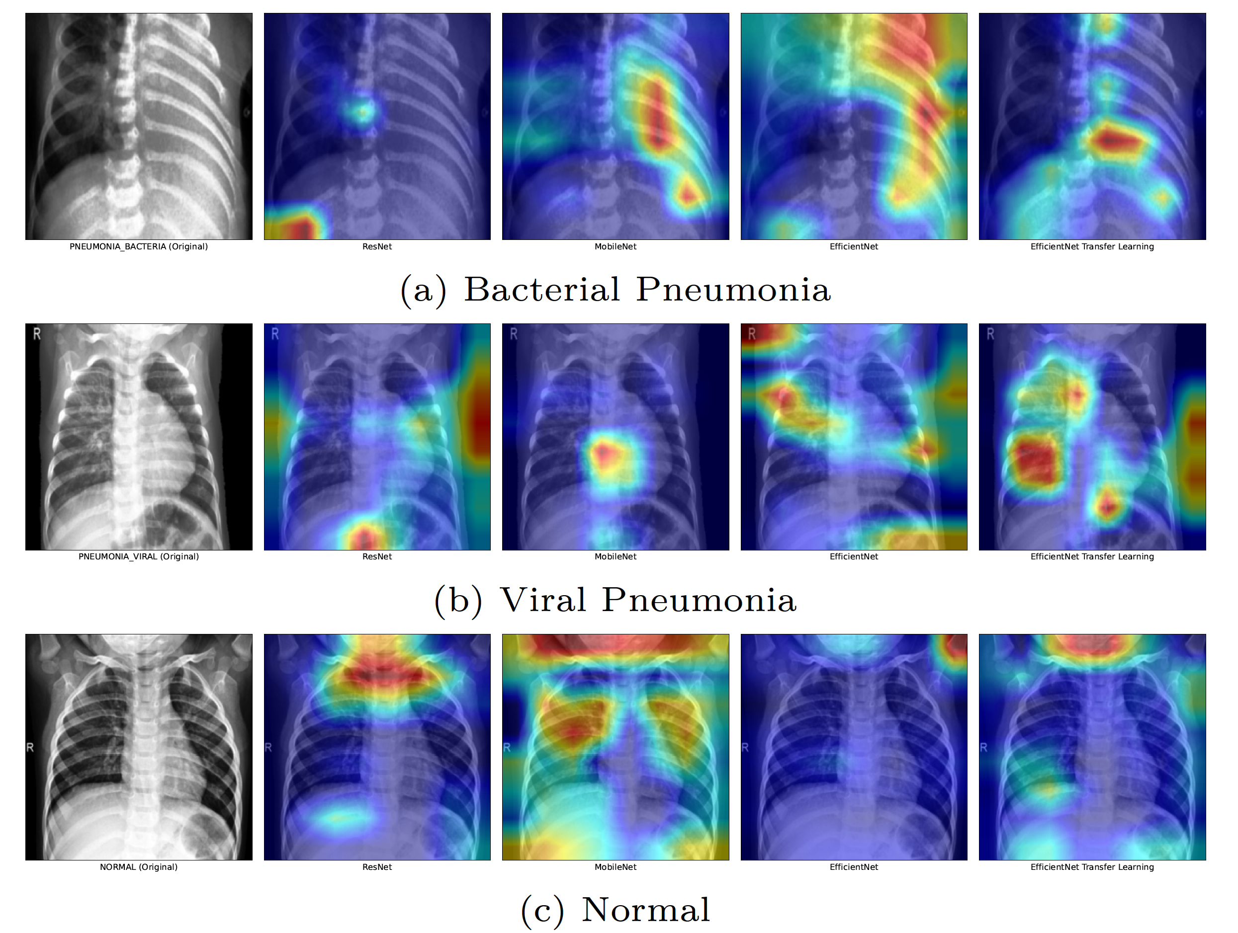 grad-cam-pneumonia